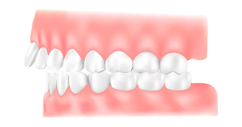 出っ歯（上顎前突）