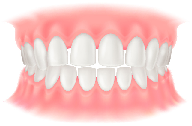 すきっ歯（空隙歯列）