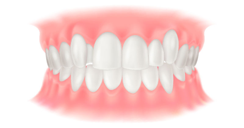 叢生（そうせい）