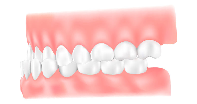 受け口（反対咬合）