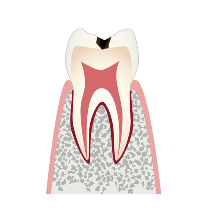 エナメル質に小さな穴が空いたむし歯