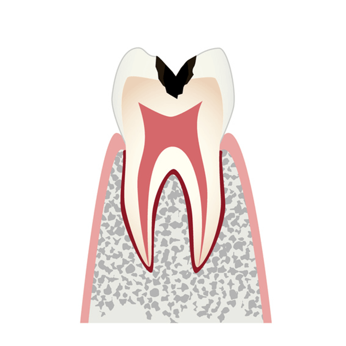 歯の内部まで進行したむし歯