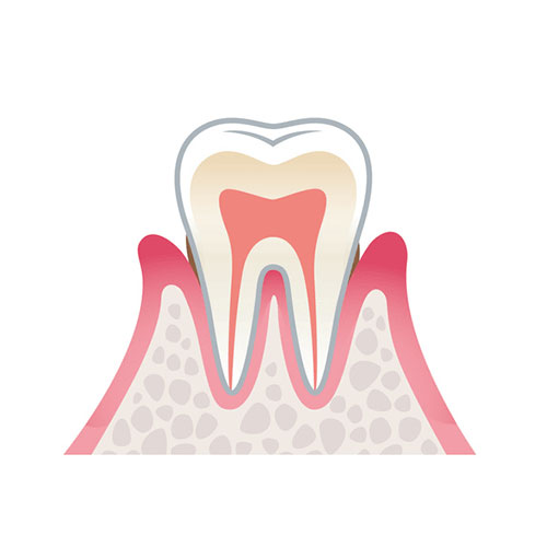 軽度歯周病